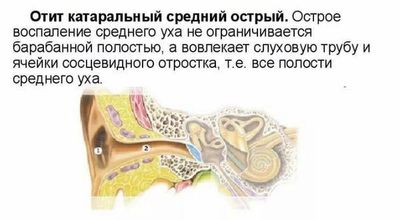 Катаральный отит