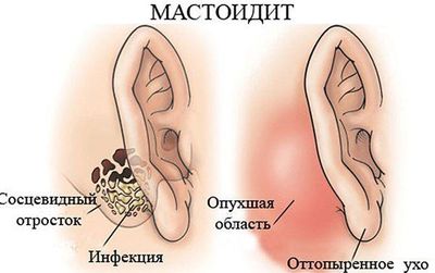 Развитие Мастоидита