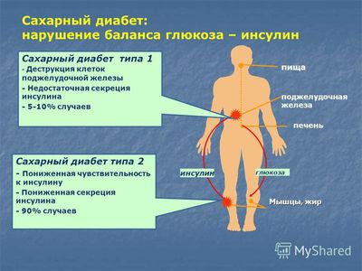 Сахарный диабет